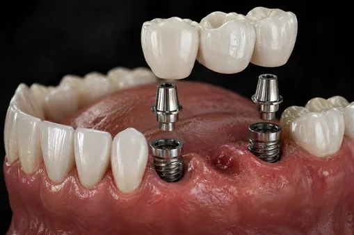 Implant-supported bridge seated over two implant abutments