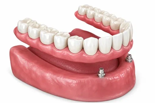 Implant overdenture with ball attachments on the lower ridge