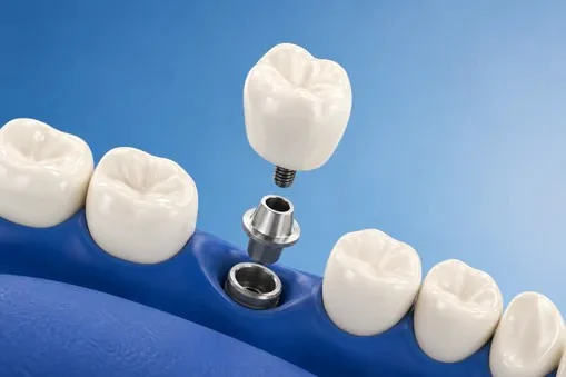 Crown being placed onto a single dental implant abutment