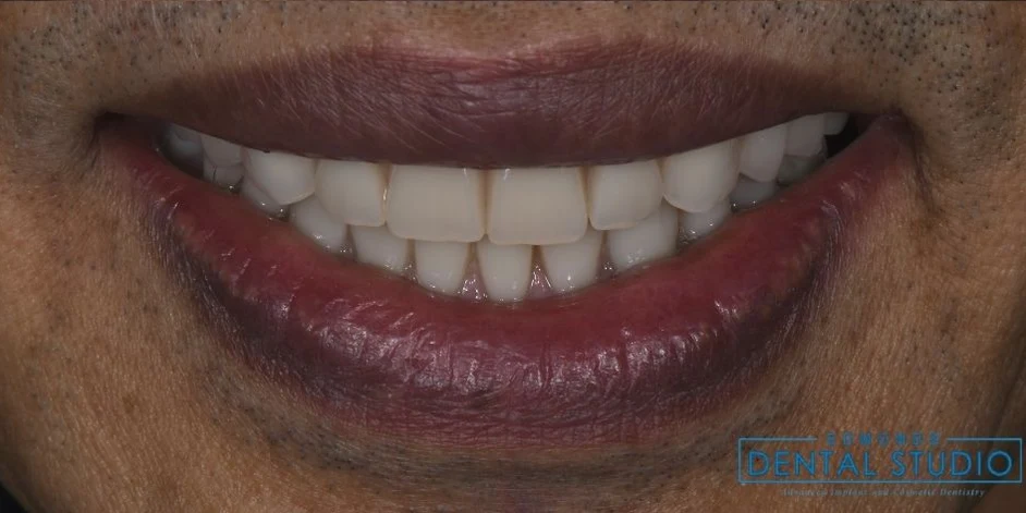 After all-on-4 / full arch at Edmonds Implant Center