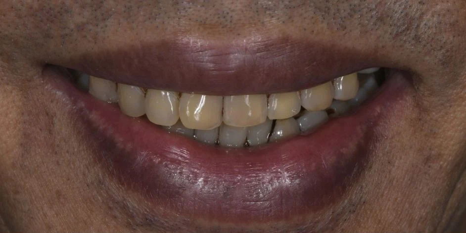 Before all-on-4 / full arch at Edmonds Implant Center