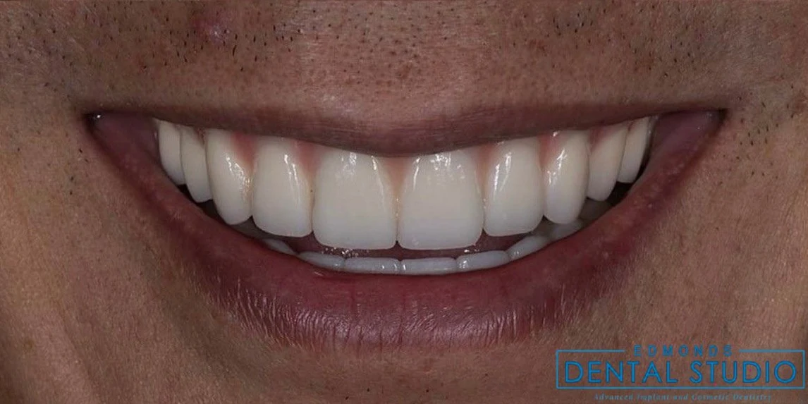 All-on-X full-arch result on an actual Edmonds Implant Center patient