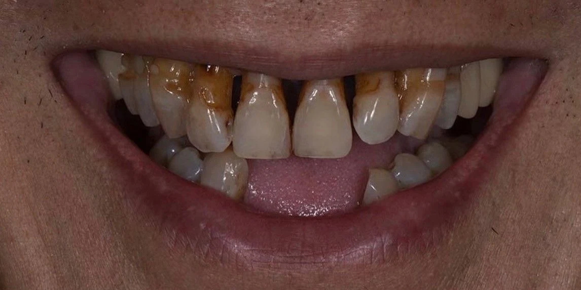 Before all-on-4 / full arch at Edmonds Implant Center