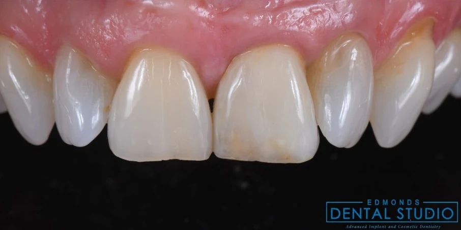 After dental implants at Edmonds Implant Center