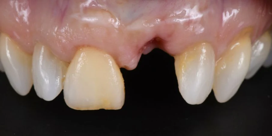 Before dental implants at Edmonds Implant Center