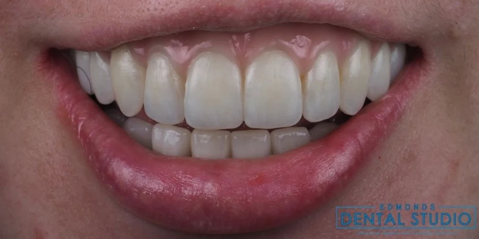 After all-on-4 / full arch at Edmonds Implant Center
