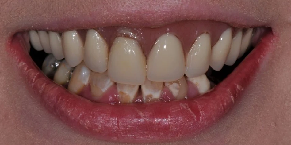 Before all-on-4 / full arch at Edmonds Implant Center