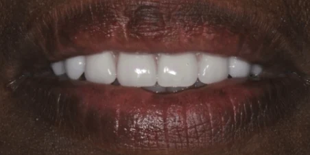After full arch implant restoration at Edmonds Implant Center