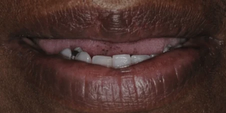 Before full arch implant restoration at Edmonds Implant Center