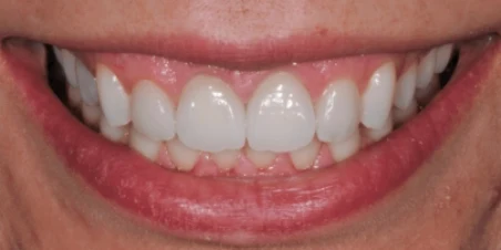 After — Crown Lengthening and Ceramic Restorations