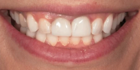 Before — Crown Lengthening and Ceramic Restorations