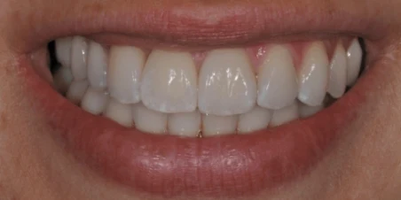 After — Immediate Implant Placement And Ceramic Restorations