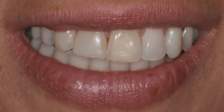 Before — Immediate Implant Placement And Ceramic Restorations