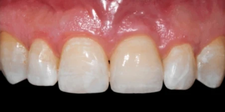 After — Immediate Implant Placement And Ceramic Restorations
