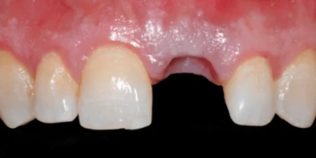 Before — Immediate Implant Placement And Ceramic Restorations