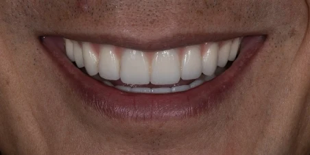 After — Full Mouth Implant Rehabilitation