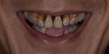 Before — Full Mouth Implant Rehabilitation