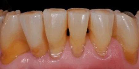 After — Implant And Ceramic Crown