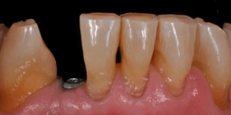 Before — Implant And Ceramic Crown