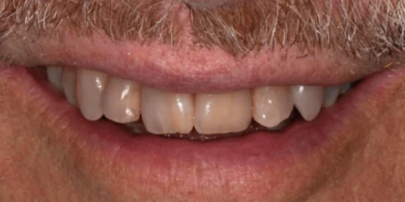 After — Single Ceramic Crown