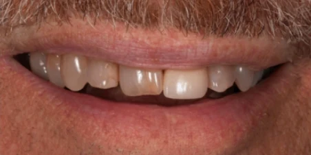 Before — Single Ceramic Crown