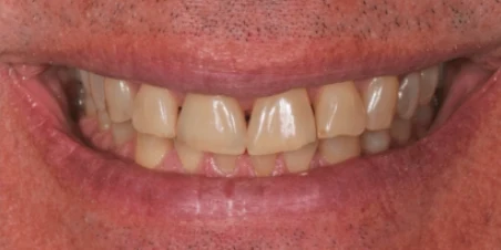 After — Single Ceramic Crown