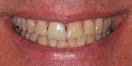 Before — Single Ceramic Crown