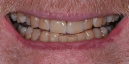 After — Multiple Ceramic Crowns