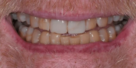 Before — Multiple Ceramic Crowns