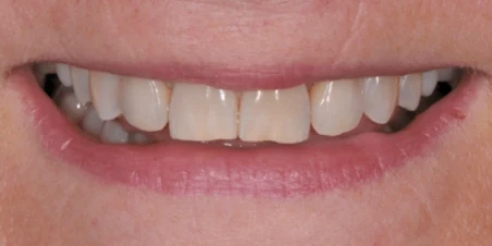 After — Multiple Ceramic Crowns