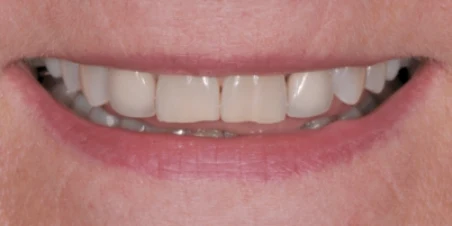 Before — Multiple Ceramic Crowns